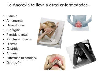 La Anorexia te lleva a otras enfermedades…
• Bulimia
• Amenorrea
• Desnutrición
• Esofagitis
• Perdida dental
• Problemas óseos
• Ulceras
• Gastritis
• Anemia
• Enfermedad cardiaca
• Depresión
 