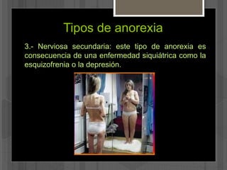Tipos de anorexia 
3.- Nerviosa secundaria: este tipo de anorexia es 
consecuencia de una enfermedad siquiátrica como la 
esquizofrenia o la depresión. 
 