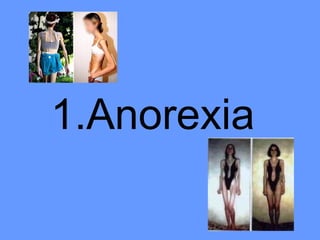 1.Anorexia 