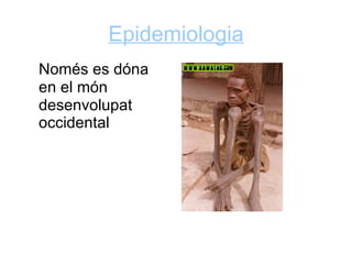 Epidemiologia
Només es dóna
en el món
desenvolupat
occidental
 