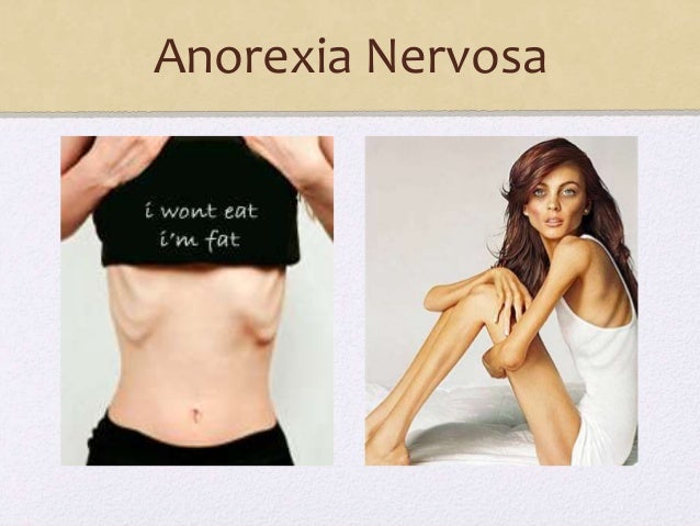 Anorexia nervosa.