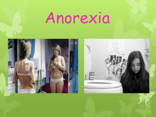 Anorexia
 