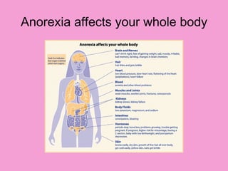 NSG3CPR Anorexia Presentation | PPT