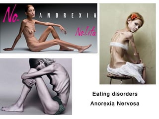 Eating disorders
Anorexia Nervosa

 