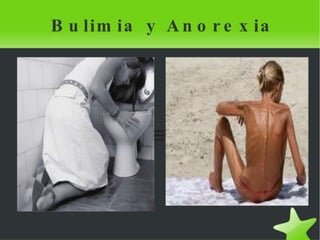 Anorexia y bulimia roc laumari