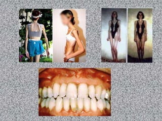 *Es hipotensa.*Padece anemia.*Niega el problema.*Tiene ideas de muerte o de suicidio.*Le teme a subir de peso a engordar.*Se mira continuamente en un espejo.*Tiene el corazón y los huesos débiles.*Sufre de mareos y desmayos muy seguido.*Tiene mayor higiene y cuidado a la imagen.*Tiene visiones distorsionadas de su imagen.*Tiene una carrera de baile, modelaje o deporte.*En las mujeres hay falta del periodo menstrual.