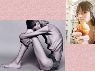 En el caso de la bulimia, los ácidos del estomago presentes en los vómitos, atraviesan la boca y erosionan el esmalte dental, provocando decoloración e incluso la perdida de dientes.En la anorexia, pueden desarrollarse osteoporosis que debiliten los huesos maxilares que sostienen los dientes, induciendo a la perdida de ellos.