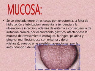 Por perdida de la dimensión vertical.La mas característica es estos pacientes, es una queilitis aguda. Se caracteriza por la presencia de escamas, vesículas y costras. CARIES:Una excesiva ingestión de carbohidratos y una pobre higiene bucal puede resultar en un aumento en prevalencia a caries dental. Medicamentos prescritos ocasionalmente en estos pacientes pueden contribuir de igual manera, tales como tabletas de dextrosa, vit. C, bebidas ricas en sacarosa, Probablemente existan adicionalmente cambios en la flora bacteriana de los microorganismos cariogénicos como S. mutans y lactobacilos. En estos pacientes puede existir grados variables de xerostomía asociada a deshidratación, estados permanentes de ansiedad y secundario a medicación depresora del SNC.