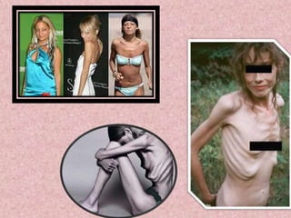 ¿PoR qUè Se Da?Se da por la gran influencia de los medios que muestran el estereotipo de una mujer “hermosa”(también a hombres) demasiado esbelta y superficial, por lo que la juventud a tratado de imitar, aunque ha llegado a extremos; Por lo mismo se crean la idea de que la esbeltez es sinónimo de belleza, aunque no tomen en cuenta otros razgos.Esta gente gasta grandes cantidades de dinero en purgantes con tal de no engordar.