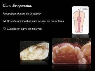 Dens Evagenatus 
Proyección externa en la corona 
 Cúspide adicional en cara oclusal de premolares 
 Cúspide en garra en incisivos 
 