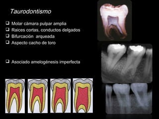 Taurodontismo 
 Molar cámara pulpar amplia 
 Raices cortas, conductos delgados 
 Bifurcación arqueada 
 Aspecto cacho de toro 
 Asociado amelogénesis imperfecta 
 