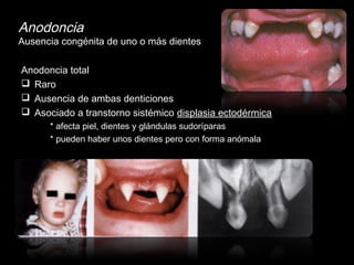 Anodoncia 
Ausencia congénita de uno o más dientes 
Anodoncia total 
 Raro 
 Ausencia de ambas denticiones 
 Asociado a transtorno sistémico displasia ectodérmica 
* afecta piel, dientes y glándulas sudoríparas 
* pueden haber unos dientes pero con forma anómala 
 
