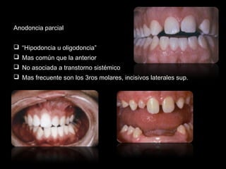 Anodoncia parcial 
 “Hipodoncia u oligodoncia” 
 Mas común que la anterior 
 No asociada a transtorno sistémico 
 Mas frecuente son los 3ros molares, incisivos laterales sup. 
 