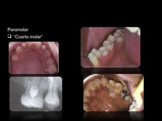 Paramolar 
 “Cuarta molar” 
 