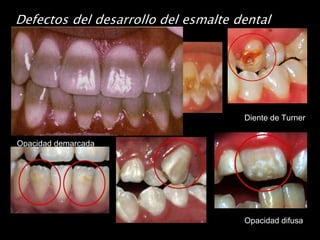 Hipoplasias de esmalte 
Diente de Turner 
Opacidad demarcada 
Opacidad difusa 
 