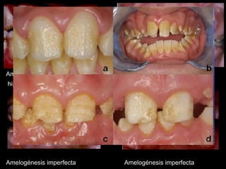 Amelogénesis imperfecta Amelogénesis imperfecta 
hipoplásica foveal hipoplásica 
Amelogénesis imperfecta Amelogénesis imperfecta 
Hipocalcificada hipomaduración 
 