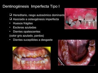 Dentinogénesis Imperfecta Tipo I 
 Hereditario, rasgo autosómico dominante 
 Asociado a osteogénesis imperfecta 
• Huesos frágiles 
• Escleras azuladas 
• Dientes opalescentes 
(color gris azulado, pardos) 
• Dientes suceptibles a desgaste 
 