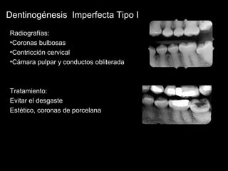 Dentinogénesis Imperfecta Tipo I 
Radiografías: 
•Coronas bulbosas 
•Contricción cervical 
•Cámara pulpar y conductos obliterada 
Tratamiento: 
Evitar el desgaste 
Estético, coronas de porcelana 
 