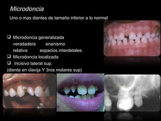 Microdoncia 
Uno o mas dientes de tamaño inferior a lo normal 
 Microdoncia generalizada 
veradadera enanismo 
relativa espacios interdetales 
 Microdoncia localizada 
 Incisivo lateral sup. 
(diente en clavija Y 3ros molares sup) 
 