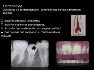 Geminación 
División de un gérmen dentario, se forman dos dientes similares (o 
gemelos) 
 Incisivos inferiores temporales 
 Incisivos superiores permantentes. 
 Al contar hay un diente de más o igual cantidad 
 Dos coronas que comparten el mismo conducto 
radicular 
 