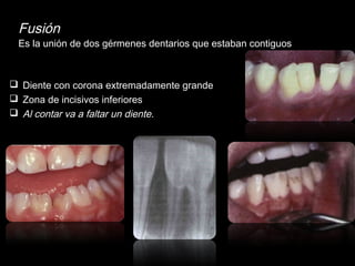 Fusión 
Es la unión de dos gérmenes dentarios que estaban contiguos 
 Diente con corona extremadamente grande 
 Zona de incisivos inferiores 
 Al contar va a faltar un diente. 
 