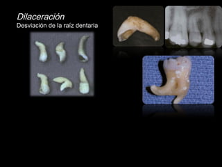 Dilaceración 
Desviación de la raíz dentaria 
 