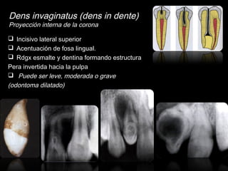 Dens invaginatus (dens in dente) 
Proyección interna de la corona 
 Incisivo lateral superior 
 Acentuación de fosa lingual. 
 Rdgx esmalte y dentina formando estructura 
Pera invertida hacia la pulpa 
 Puede ser leve, moderada o grave 
(odontoma dilatado) 
 