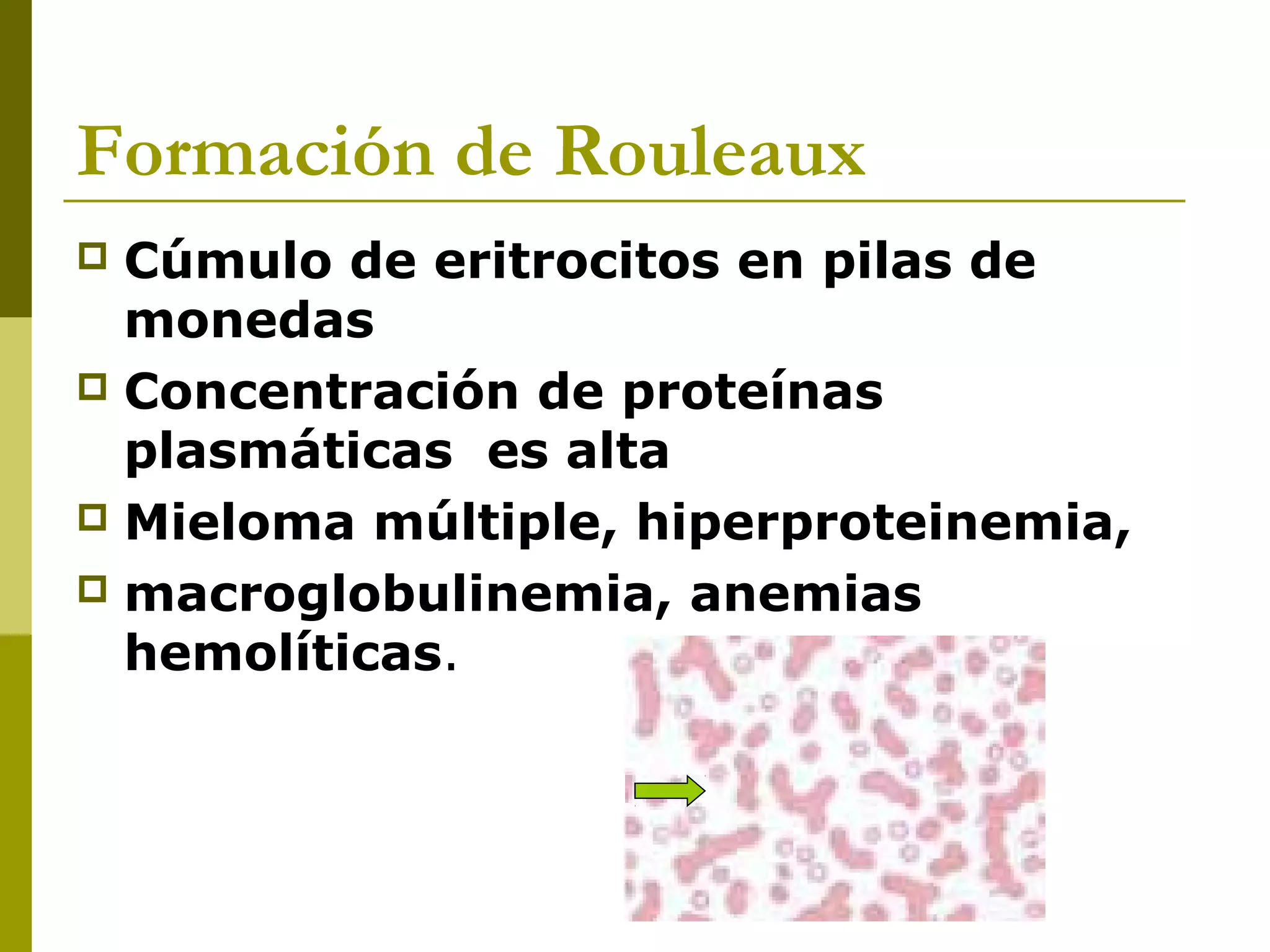 Formación de Rouleaux
 Cúmulo de eritrocitos en pilas de
monedas
 Concentración de proteínas
plasmáticas es alta
 Mieloma múltiple, hiperproteinemia,
 macroglobulinemia, anemias
hemolíticas.
 