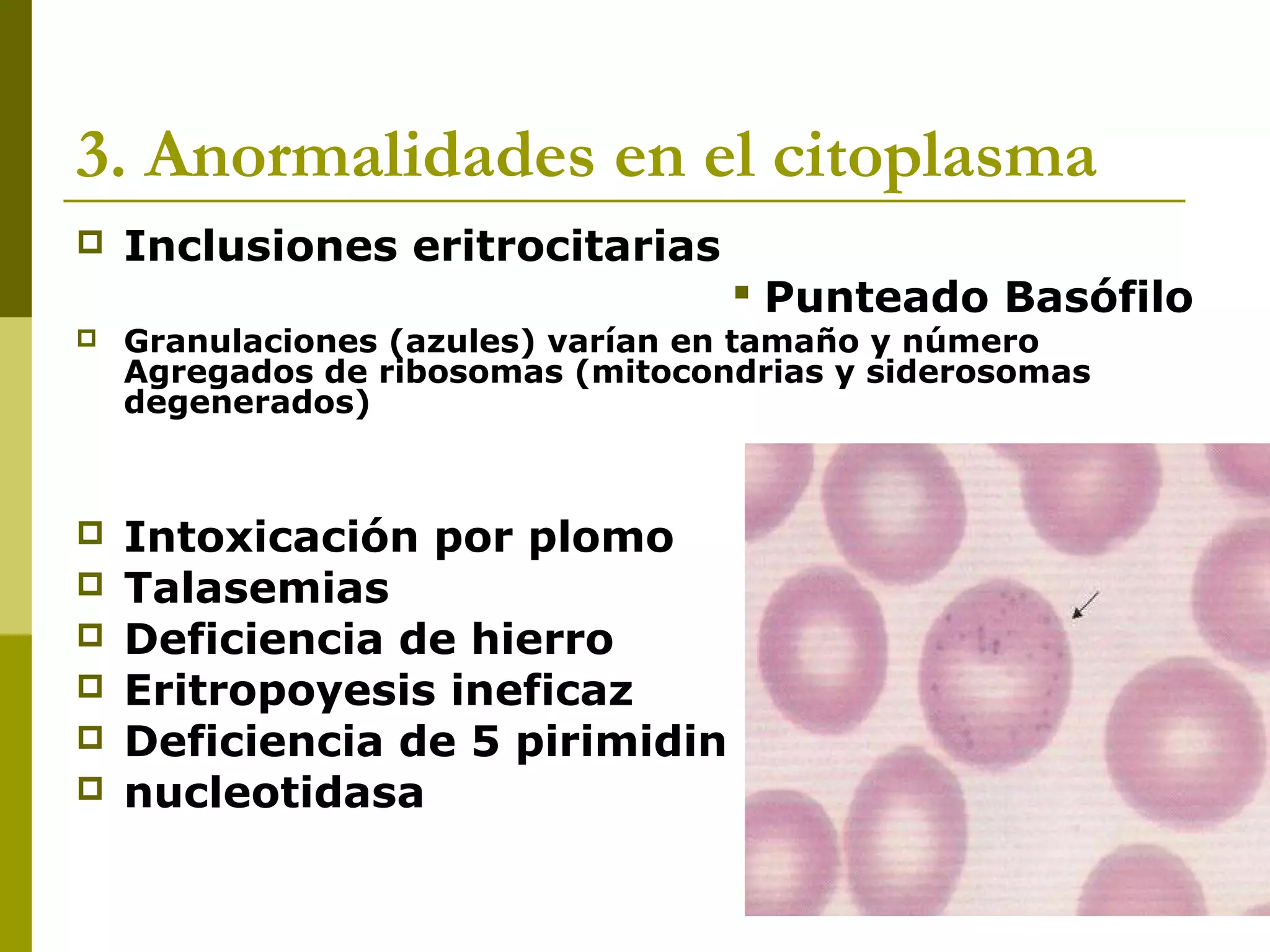 3. Anormalidades en el citoplasma
 Inclusiones eritrocitarias
 Punteado Basófilo
 Granulaciones (azules) varían en tamaño y número
Agregados de ribosomas (mitocondrias y siderosomas
degenerados)
 Intoxicación por plomo
 Talasemias
 Deficiencia de hierro
 Eritropoyesis ineficaz
 Deficiencia de 5 pirimidin
 nucleotidasa
 