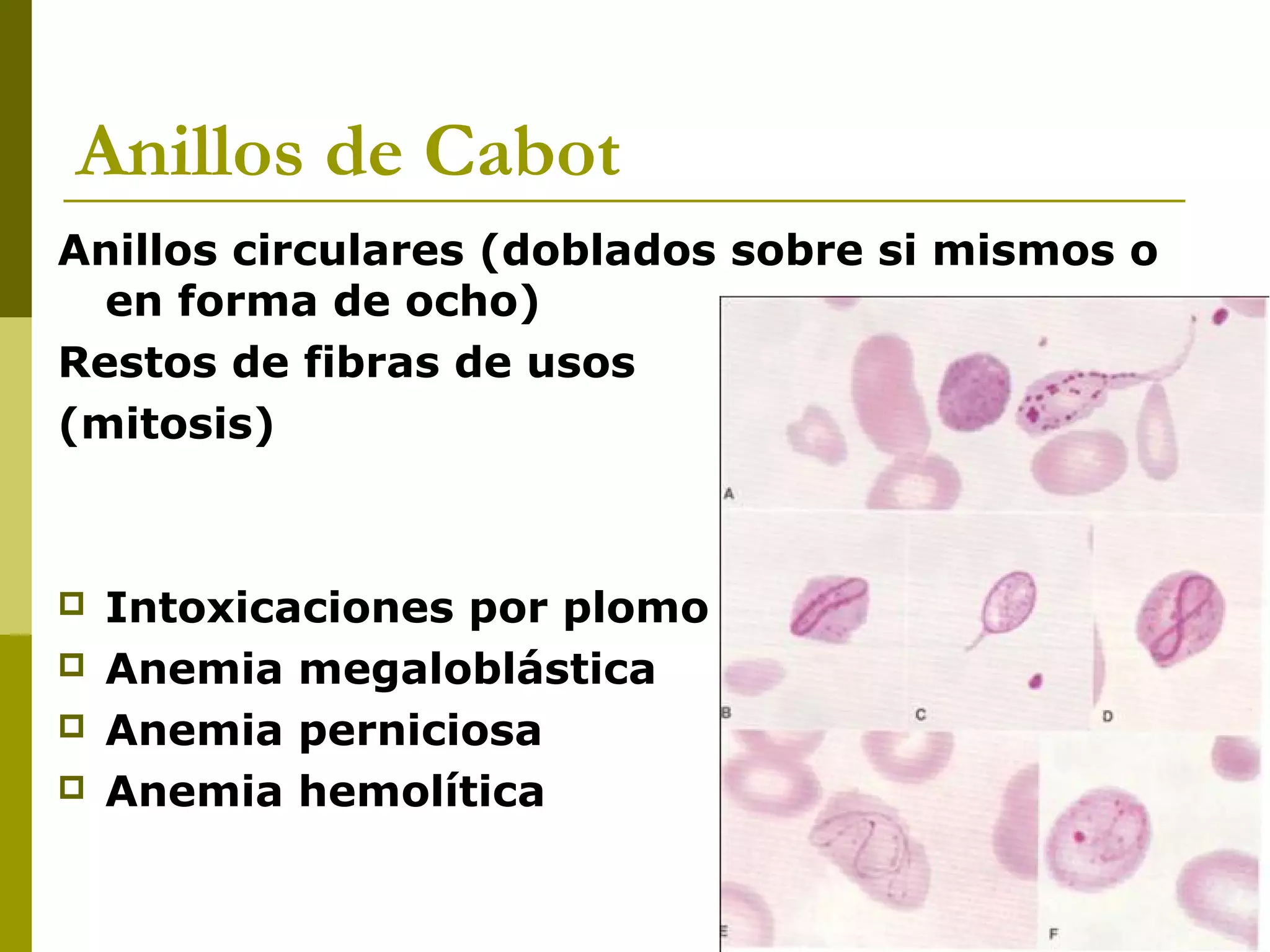 Anillos de Cabot
Anillos circulares (doblados sobre si mismos o
en forma de ocho)
Restos de fibras de usos
(mitosis)
 Intoxicaciones por plomo
 Anemia megaloblástica
 Anemia perniciosa
 Anemia hemolítica
 