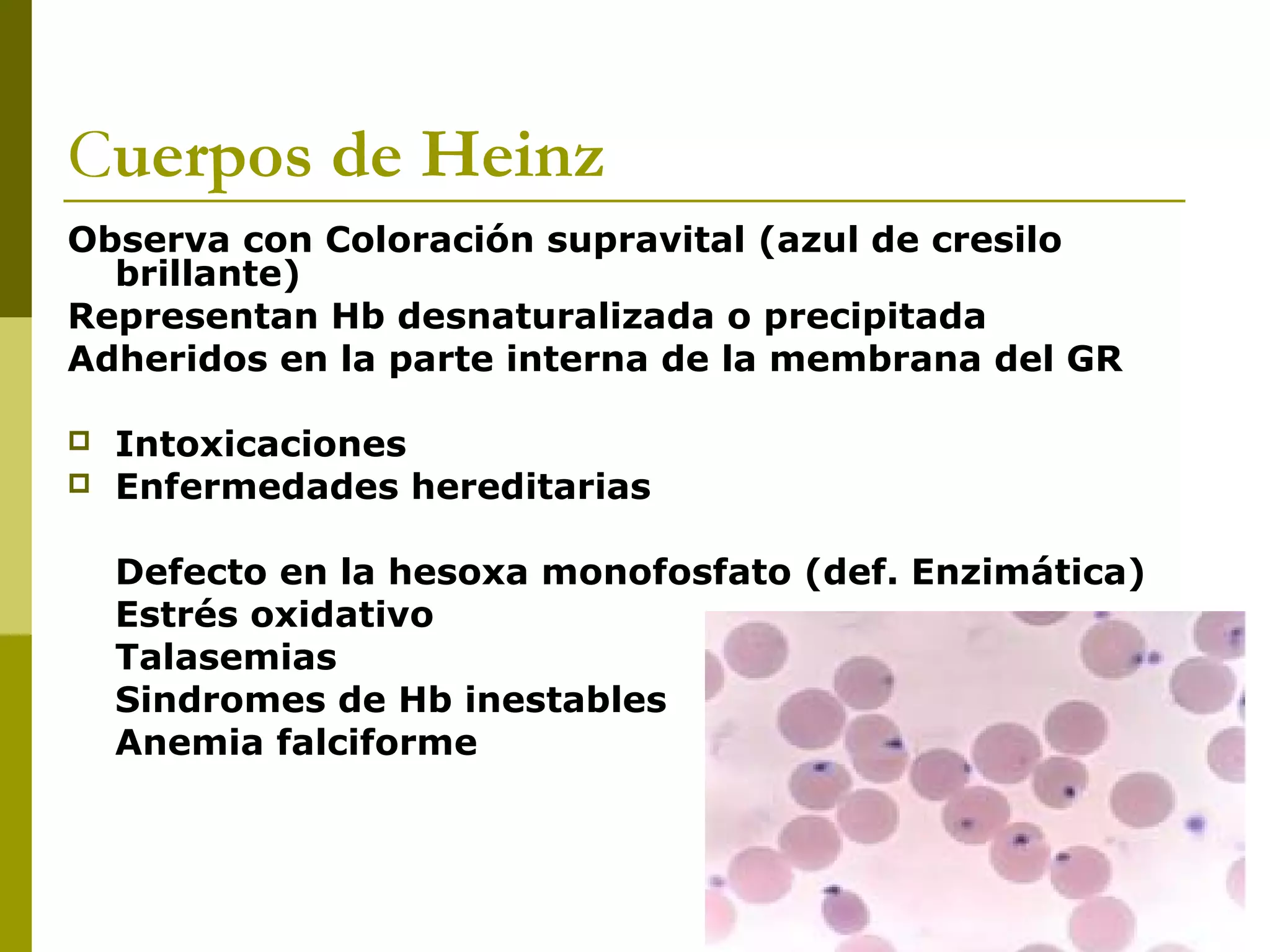 Cuerpos de Heinz
Observa con Coloración supravital (azul de cresilo
brillante)
Representan Hb desnaturalizada o precipitada
Adheridos en la parte interna de la membrana del GR
 Intoxicaciones
 Enfermedades hereditarias
Defecto en la hesoxa monofosfato (def. Enzimática)
Estrés oxidativo
Talasemias
Sindromes de Hb inestables
Anemia falciforme
 