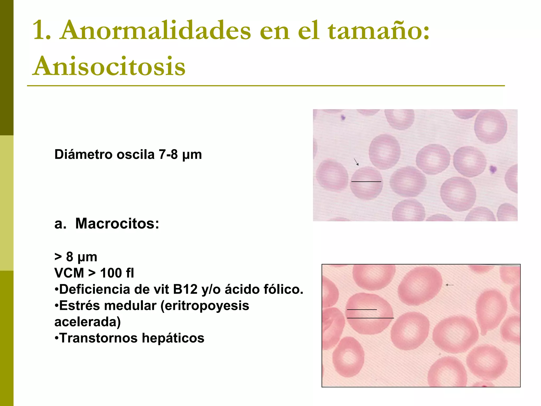 1. Anormalidades en el tamaño:
Anisocitosis
Diámetro oscila 7-8 μm
a. Macrocitos:
> 8 μm
VCM > 100 fl
•Deficiencia de vit B12 y/o ácido fólico.
•Estrés medular (eritropoyesis
acelerada)
•Transtornos hepáticos
 