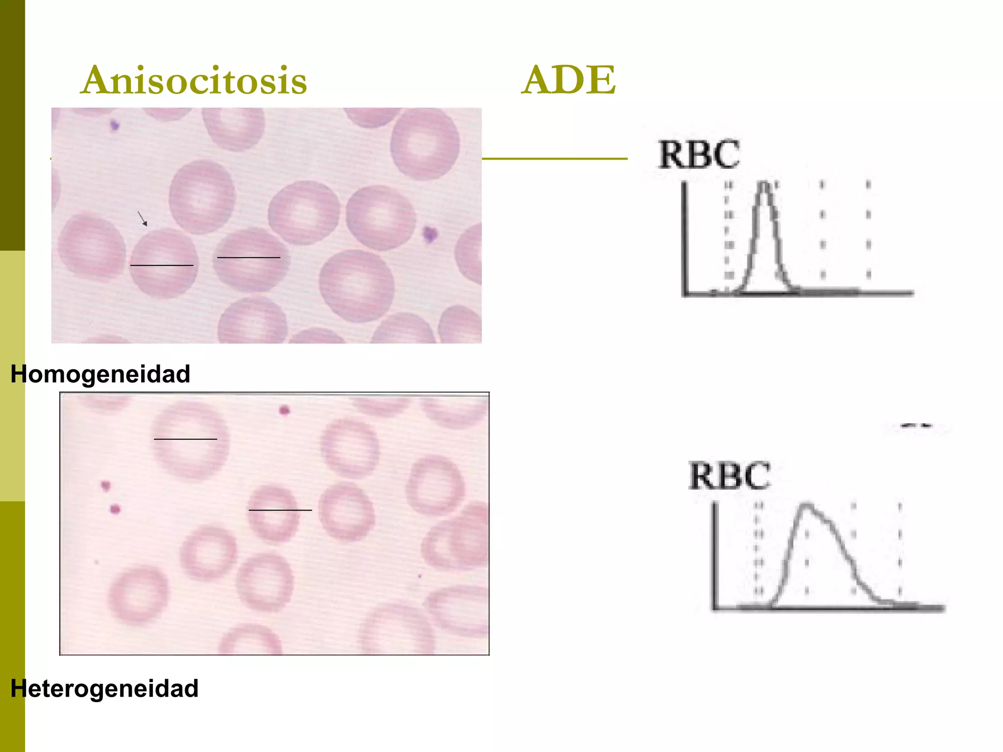 Anisocitosis ADE
Homogeneidad
Heterogeneidad
 