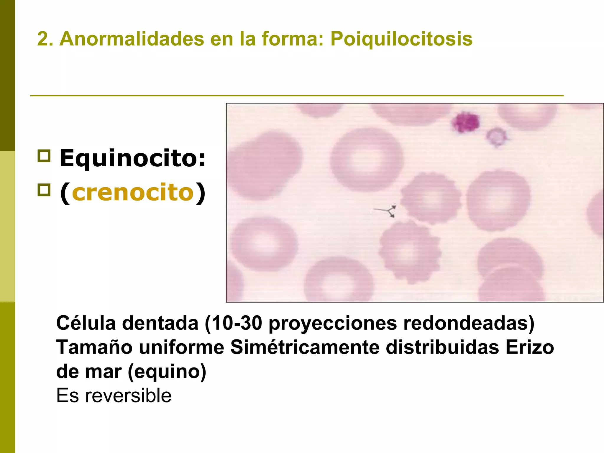  Equinocito:
 (crenocito)
2. Anormalidades en la forma: Poiquilocitosis
Célula dentada (10-30 proyecciones redondeadas)
Tamaño uniforme Simétricamente distribuidas Erizo
de mar (equino)
Es reversible
 