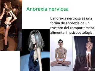 Anorèxia nerviosaL’anorèxia nerviosa és una forma de anorèxia de un trastorn del comportament  alimentari i psicopatològic.