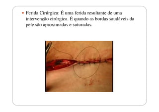 Ferida Cirúrgica: É uma ferida resultante de uma
intervenção cirúrgica. É quando as bordas saudáveis da
pele são aproximadas e suturadas.

 