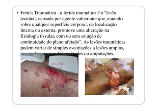 Ferida Traumática - a ferida traumática é a "lesão
tecidual, causada por agente vulnerante que, atuando
sobre qualquer superfície corporal, de localização
interna ou externa, promove uma alteração na
fisiologia tissular, com ou sem solução de
continuidade do plano afetado". As lesões traumáticas
podem variar de simples escoriações a lesões amplas,
que podem causar deformidades ou amputações.

 