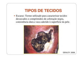 TIPOS DE TECIDOS
Escaras: Termo utilizado para caracterizar tecidos
dessecados e comprimidos de coloração negra,
consistência dura e seca aderido à superfície da pele.

DEALEY, 2008

 