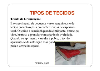 TIPOS DE TECIDOS
Tecido de Granulação:
É o crescimento de pequenos vasos sanguíneos e de
tecido conectivo para preencher feridas de espessura
total. O tecido é saudável quando é brilhante, vermelho
vivo, lustroso e granular com aparência aveludada.
Quando o suprimento vascular é pobre, o tecido
apresenta-se de coloração rosa pálido ou esbranquiçado
para o vermelho opaco.

DEALEY, 2008

 
