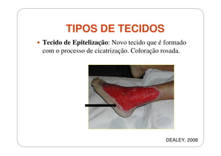 TIPOS DE TECIDOS
Tecido de Epitelização: Novo tecido que é formado
com o processo de cicatrização. Coloração rosada.

DEALEY, 2008

 