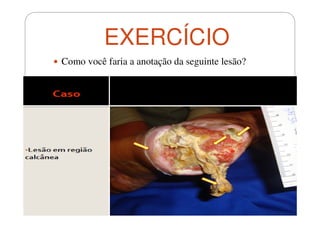 EXERCÍCIO
Como você faria a anotação da seguinte lesão?

 