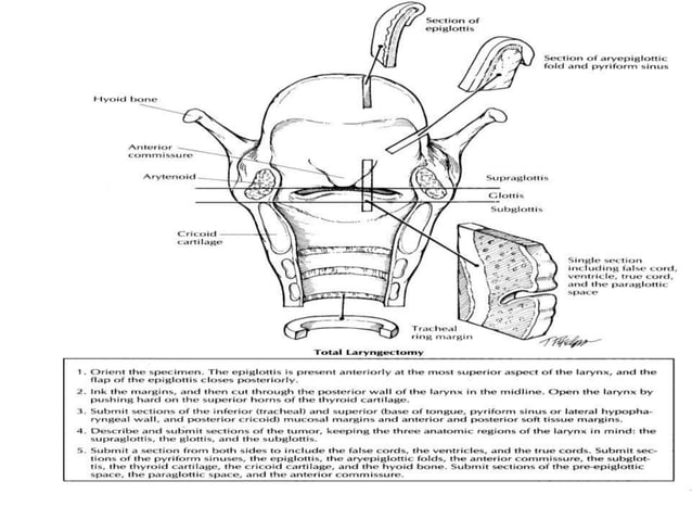 larynx Grossiing, Total laryngectomy, | PPTX | Ear, Nose and Throat ...