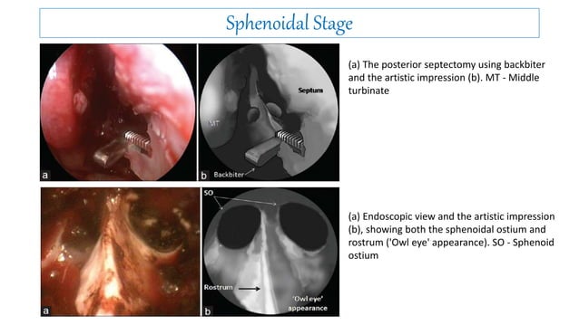 An Overview of Endoscopic endonasal Trans sphenoidal approach.pptx