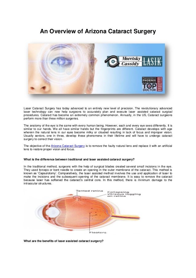 An overview of arizona cataract surgery