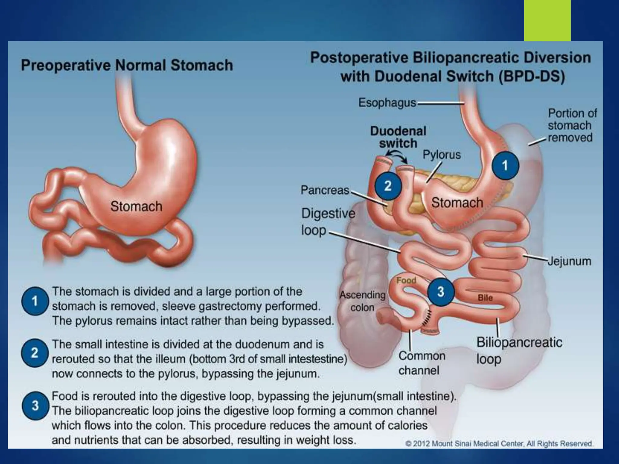 An Overview of Bariatric Surgery- shaheed.pptx