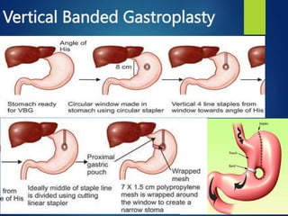 An Overview of Bariatric Surgery- shaheed.pptx