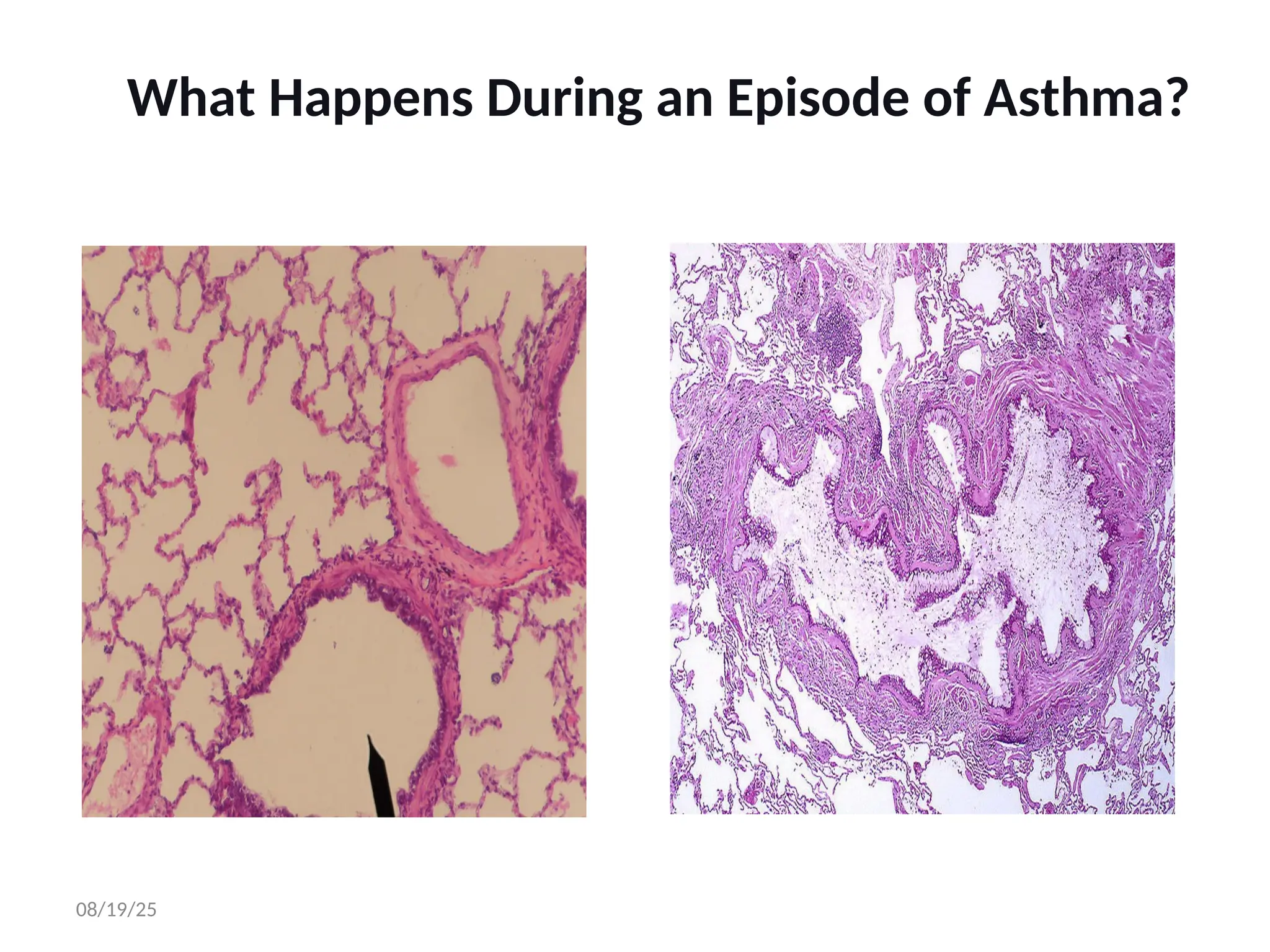 What Happens During an Episode of Asthma?
08/19/25
 