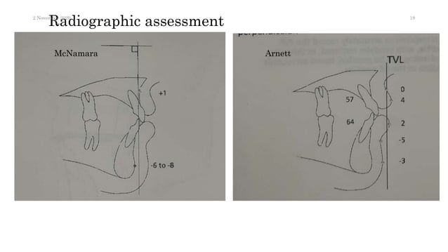 An overview of class III treatment in fixed Orthodontics by MBT system ...