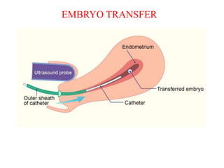 Operative Note Embryo Transfer An overview of IVF/ICSI | PPTX