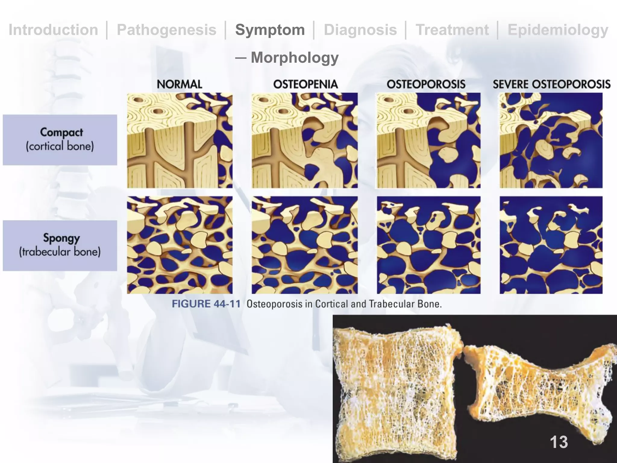 An overview of osteoporosis | PDF